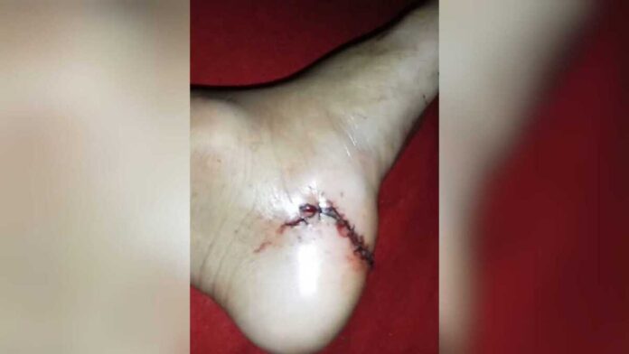 Mãe diz que médica costurou pé do filho com vidro dentro e relata descaso no Coophavila (vídeo)